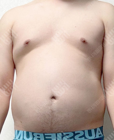 Gynecomastia4 전
