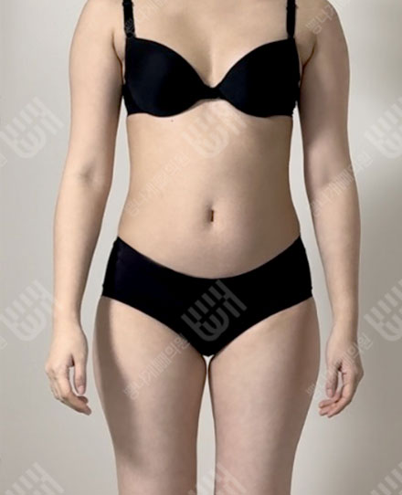 Pelvis Fat grafting 4 전