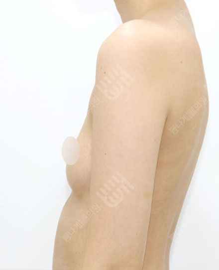 Breast Fat grafting1-1 전
