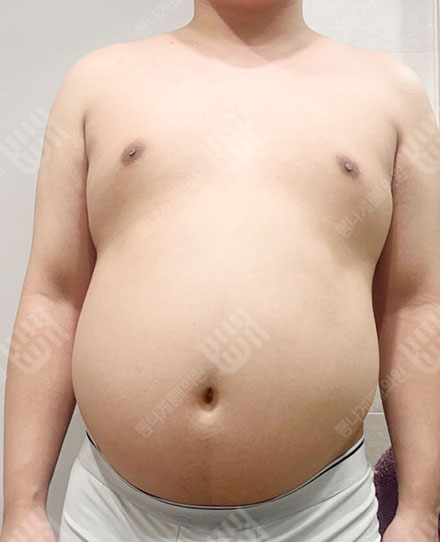 MaleAbdomen5 전