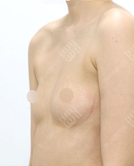 Breast Fat grafting1-2 전