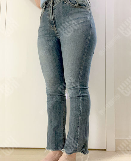 ThighsLiposuction2 전