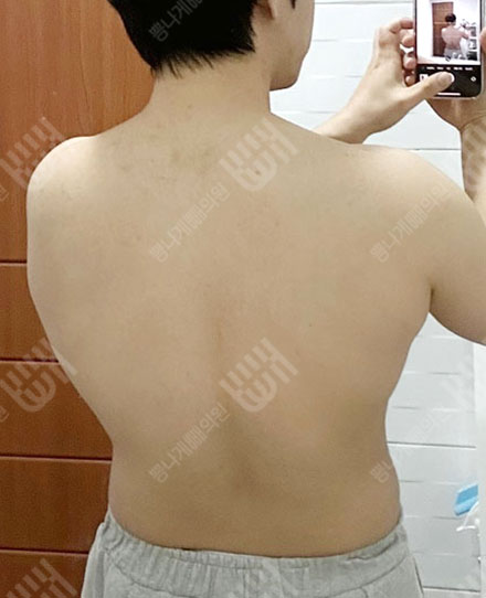 MaleBackLiposuction1 전