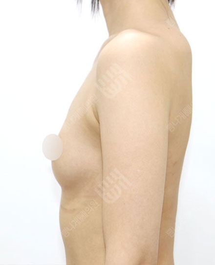 Breast Fat grafting4-1 전