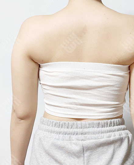 BackLiposuction1 전