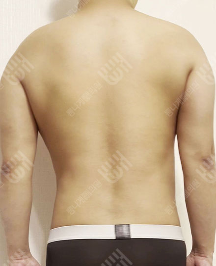 MaleBackLiposuction2 후