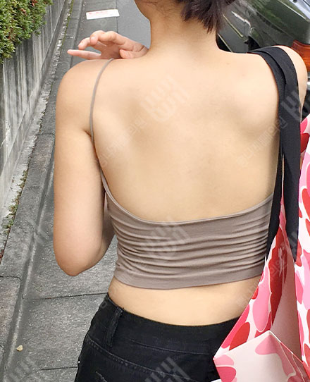 BackLiposuction1 후