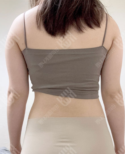 BackLiposuction2 전