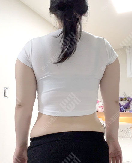 BackLiposuction3 전