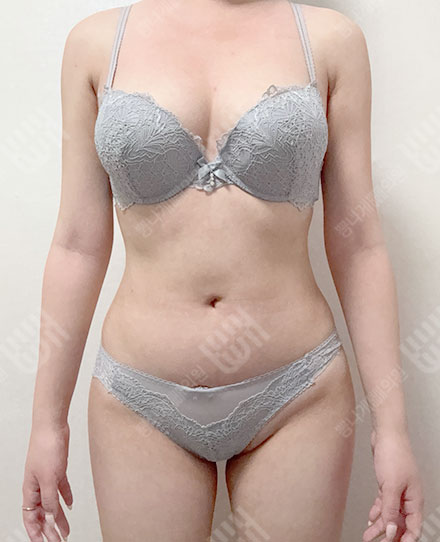 Pelvis Fat grafting5 후