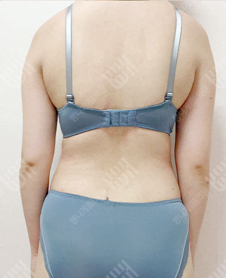 BackLiposuction8 전