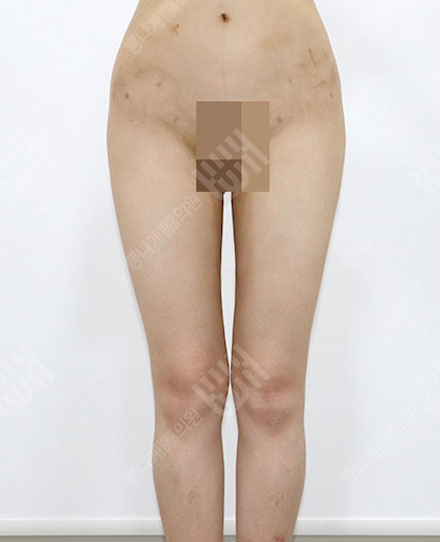 ReoperationLiposuction6 후