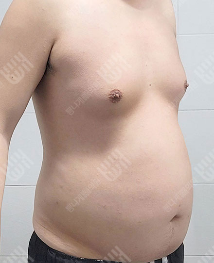 Gynecomastia3 전