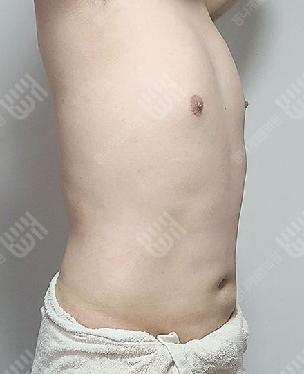 Gynecomastia3 후