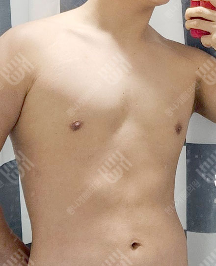 Gynecomastia2 후