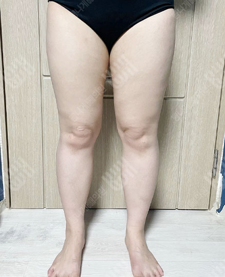 ThighsLiposuction4 전