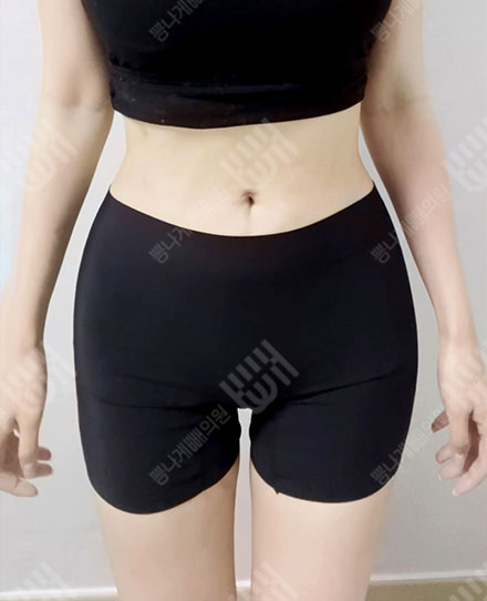 Pelvis Fat grafting8 후