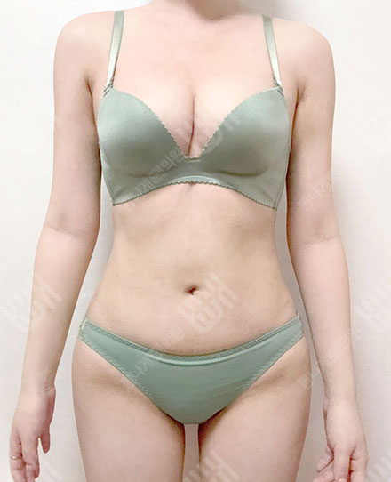 Pelvis Fat grafting10 후