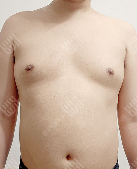Gynecomastia5 전
