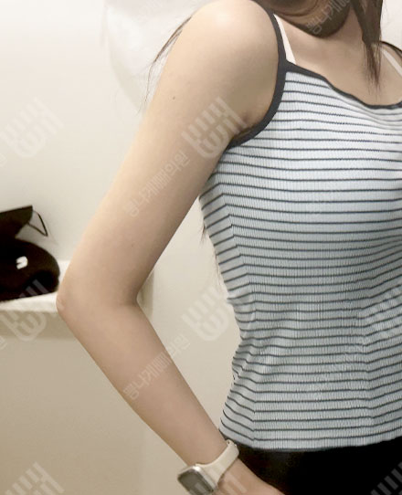 ForearmLiposuction 3 후