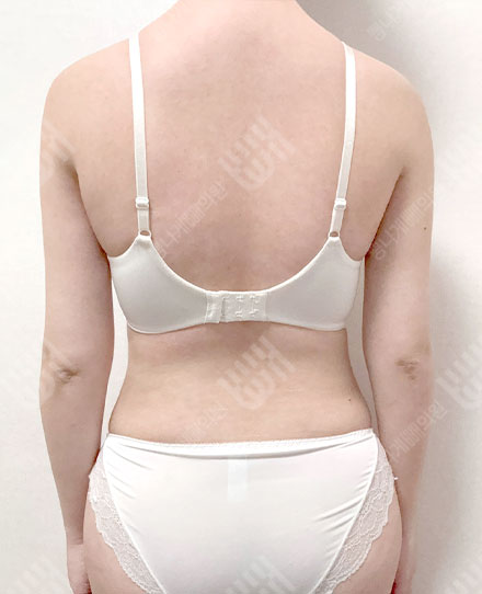 BackLiposuction8 후