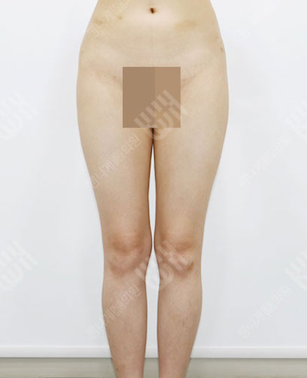 ReoperationLiposuction6 전