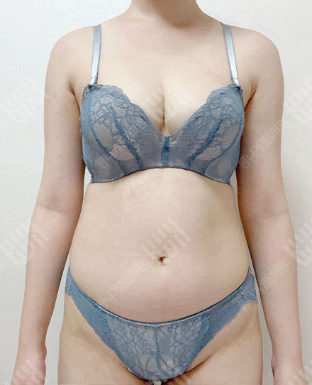 Pelvis Fat grafting10 전