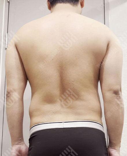 MaleBackLiposuction2 전