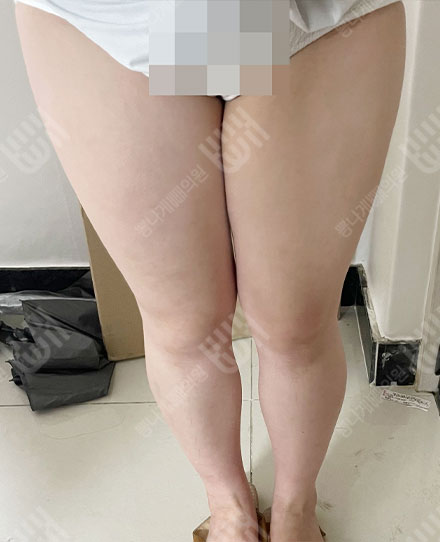 ThighsLiposuction 전