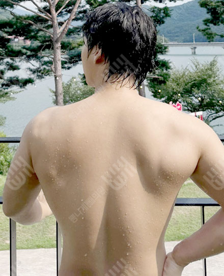 MaleBackLiposuction1 후