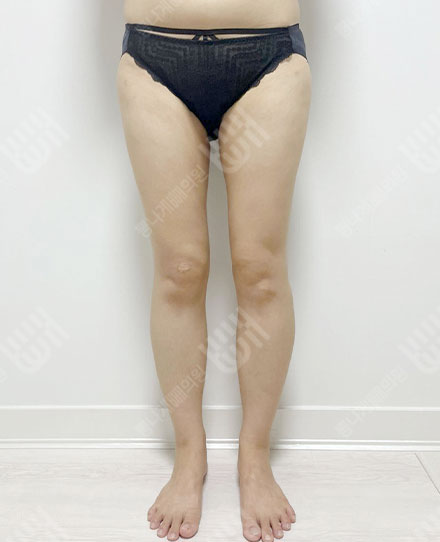 ThighsLiposuction4 후