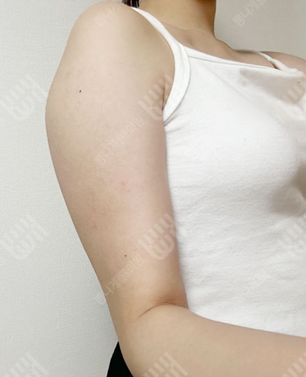 ForearmLiposuction 3 전