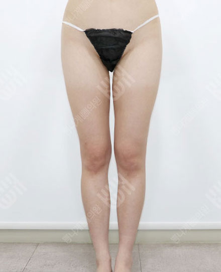 ReoperationLiposuction 3 전
