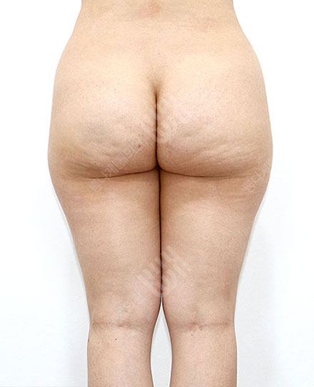 HipsLiposuction 3 전