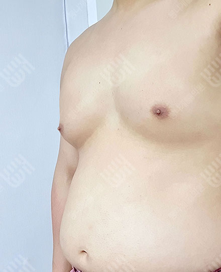 Gynecomastia2 전