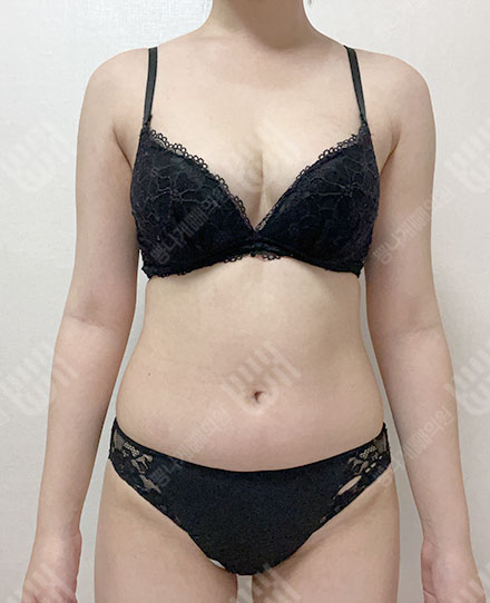Pelvis Fat grafting5 전