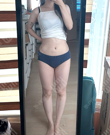Pelvis Fat grafting 3 후