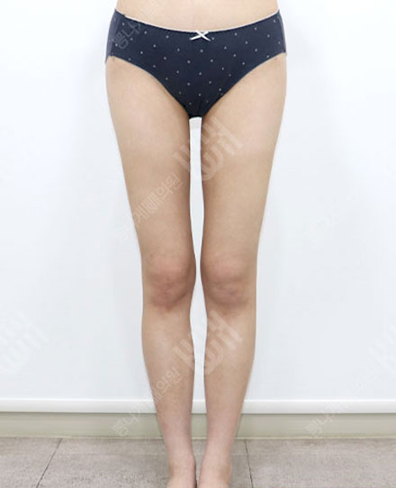 ReoperationLiposuction 3 후