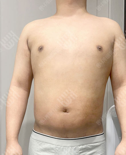 MaleAbdomen5 후