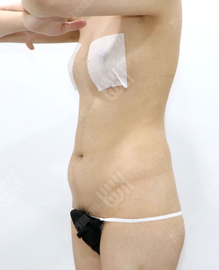 ReoperationLiposuction 2 전
