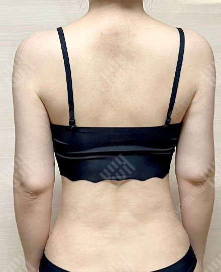 BackLiposuction4 후