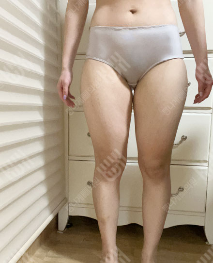 Pelvis Fat grafting6 전