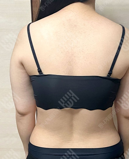 BackLiposuction4 전