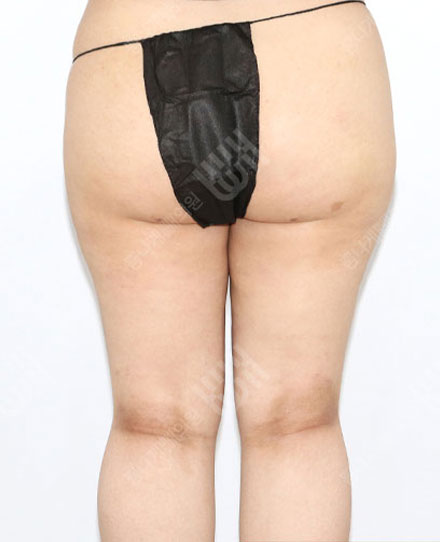 HipsLiposuction 후