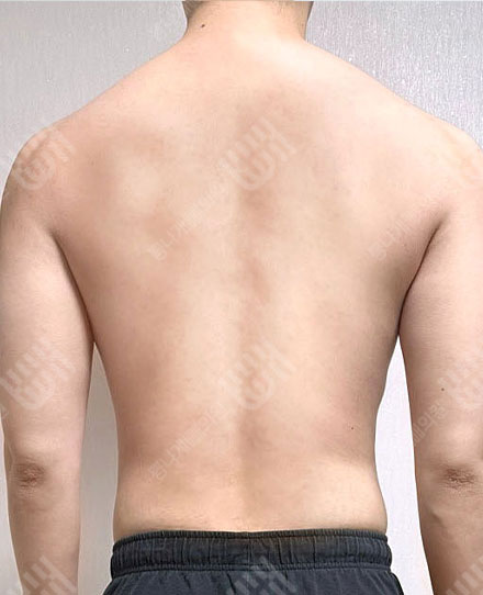 MaleBackLiposuction3 후