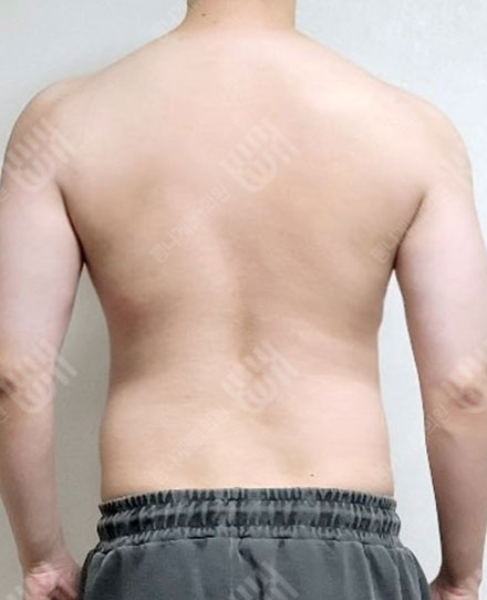 MaleBackLiposuction3 전
