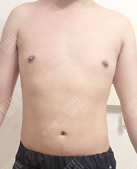 Gynecomastia5 후
