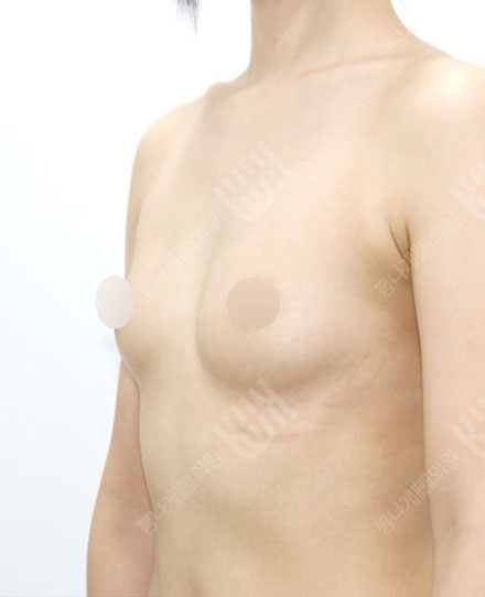 Breast Fat grafting4-2 전