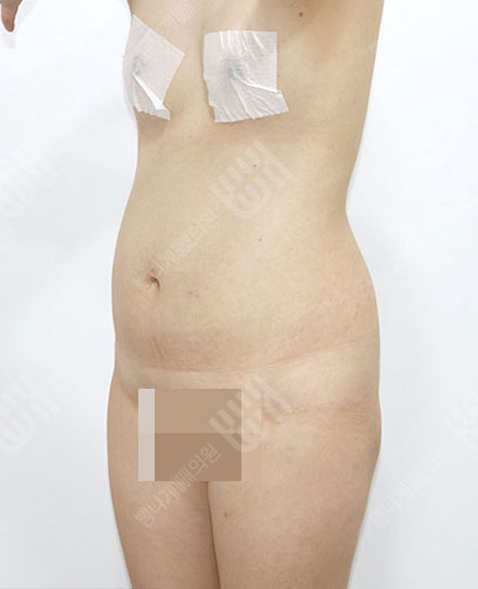 ReoperationLiposuction5 전