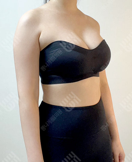 ForearmLiposuction8 전